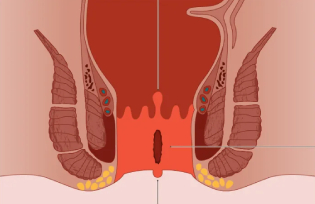 Anal Fissure Treatment Hyderabad