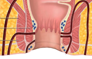 Fistula In Ano Treatment Hyderabad