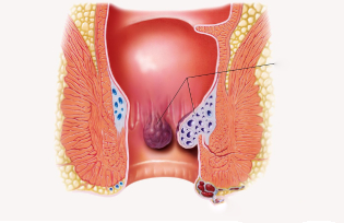 Hemorrhoids Treatment Hyderabad