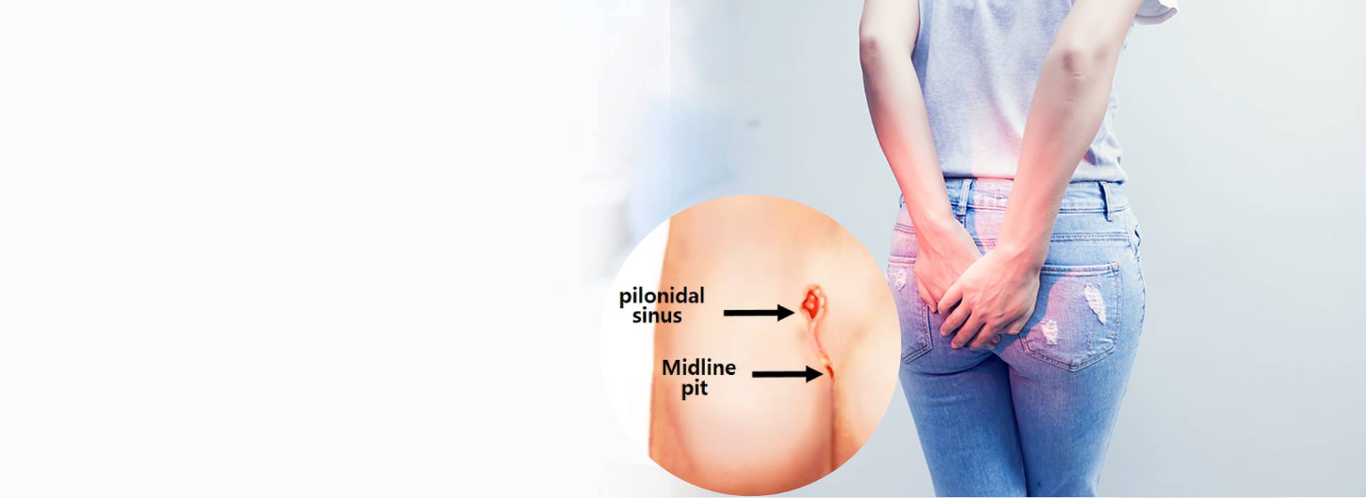 Pilonidal Sinus