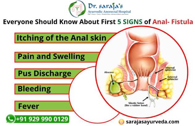 Everyone Should Know About First 5 Signs of Anal- Fistula