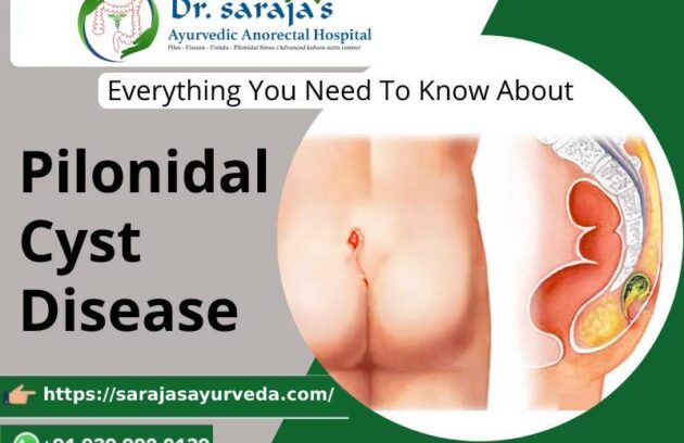 Everything You Need To Know About Pilonidal Cyst Disease