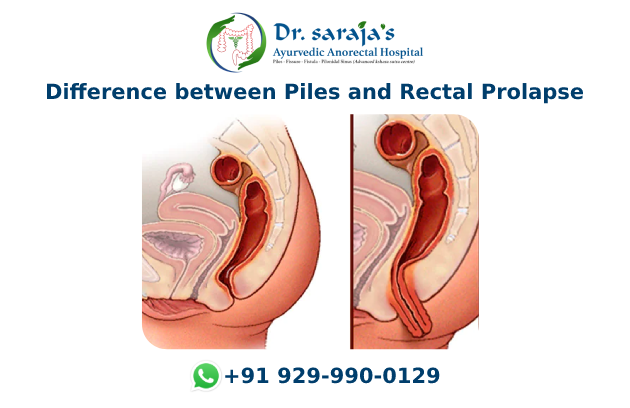 Difference between Piles and Rectal Prolapse