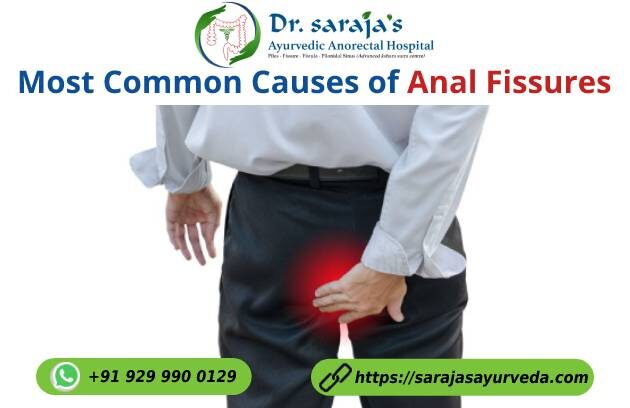 Most Common Causes of Anal Fissures