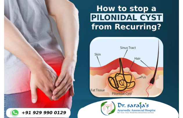 How to stop a Pilonidal Cyst from Recurring