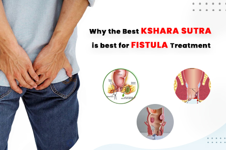 fistula treatment